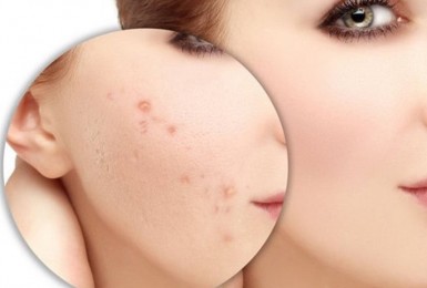 Góc giải đáp: Nghệ đen có tác dụng trị sẹo không?