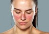 Artemisinin – phương pháp mới, đầy hứa hẹn trong điều trị bệnh Lupus ban đỏ hệ thống (Artemisin lupus)